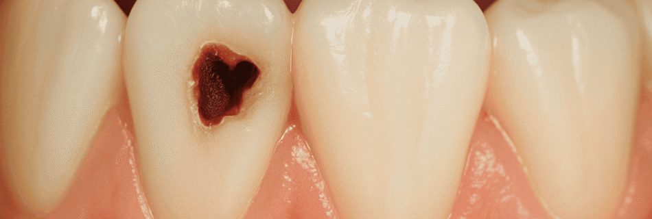 Close-up de dente com cárie escura visível no esmalte, ao lado de dentes saudáveis e gengiva rosada.